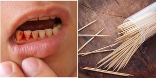Cảnh báo: Xỉa răng bằng tăm sau khi ăn có thể khiến người dùng có nguy cơ mắc bệnh nguy hiểm