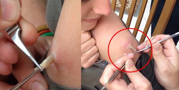 Cận cảnh pha gắp ấu trùng "ruồi trâu" to như viên đạn xem nổi cả da gà