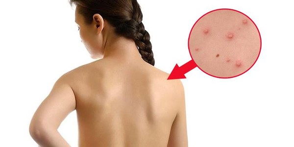 7 nguyên nhân gây ra mụn ở lưng và ngực mà phái nữ thường mắc phải