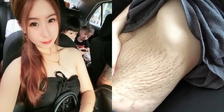 Đăng ảnh vùng bụng rạn da sau khi sinh con thứ 4, cô gái 23 tuổi khiến CĐM tranh cãi