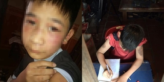 Hà Nội: Bố đẻ và mẹ kế đánh con trai 14 tuổi bầm dập cơ thể, tụ máu ở mắt