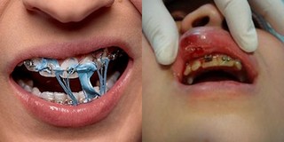 Cảnh báo: Nguy cơ bị nhiễm trùng máu, thậm chí có thể bị đột quỵ do sử dụng niềng răng