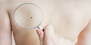 Những dấu hiệu ung thư tiết lộ qua nốt ruồi mà bạn không thể bỏ qua