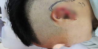 Hy hữu: Nam thanh niên bị bạn cắn đứt tai trong khi ngồi nhậu