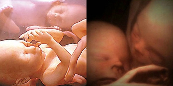 Hai em bé sinh đôi nằm trong bụng mẹ đánh nhau "dữ dội" để tranh nhau làm anh