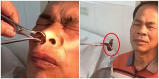 Rợn người cảnh bác sĩ gắp được cả một con đỉa còn sống trong mũi bệnh nhân