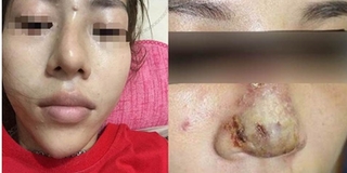 Mũi xuất hiện ổ mủ sau khi tiêm filler