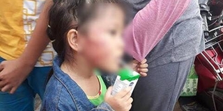 Vụ bé 5 tuổi bị tát sưng mặt ở trường mầm non: Bắt khẩn cấp bảo mẫu