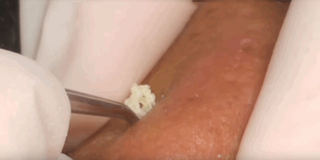 Phê lòi - Kỳ 03: "Đã đời" xem video nặn mụn ẩn: Nhìn da chả có gì mà nhấn phát là nhân mụn trào ra