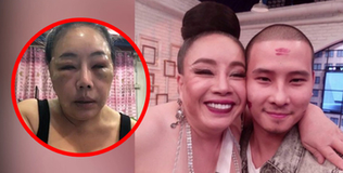 Nữ đại gia Thái Lan “yêu” 28 lần/ngày bị chồng trẻ bạo hành đến nỗi mặt biến dạng?