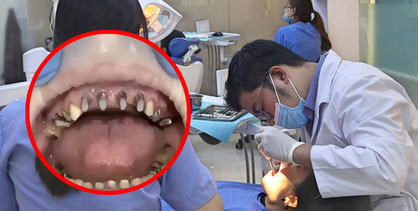 Góc Cảnh Giác: Cô gái trẻ rơi cả hàm răng sau khi bọc răng sứ