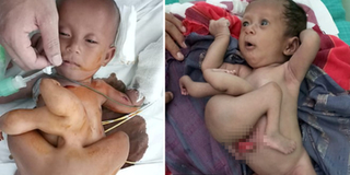 Xót xa trước hình ảnh bé gái 7 tháng tuổi vừa sinh ra đã mang dị tật ghê rợn: "mọc" thêm tay chân