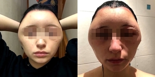Dị ứng thuốc nhuộm tóc, cô gái trẻ đầu bị phình to, biến dạng như "người ngoài hành tinh"