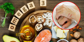 Thực Dưỡng: 5 nhóm thực phẩm giúp cải thiện làn da có mụn, ngăn ngừa sẹo và vết thâm hình thành