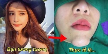 Góc Cảnh Giác: Cô gái tiêm filler với mong muốn sở hữu cằm V-line nhưng lại nhận cái kết đau đớn Góc Cảnh Giác: Cô gái tiêm filler với mong muốn sở hữu cằm V-line nhưng lại nhận cái kết đau đớn