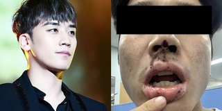 Nạn nhân nam vụ bạo hành tại club của Seungri: "Tôi bị đánh đập, làm nhục trước đám đông"
