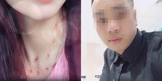 Nhờ CĐM soi vết lạ trên cổ bạn gái, chàng trai yêu xa 10.000km đau lòng phát hiện bị “cắm sừng”