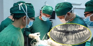 Thiếu niên phẫu thuật lấy ra gần 100 cái răng trong miệng: Tai họa đến từ sự chủ quan Thiếu niên phẫu thuật lấy ra gần 100 cái răng trong miệng: Tai họa đến từ sự chủ quan