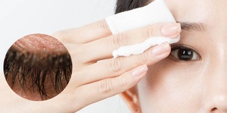 Không tẩy trang, người phụ nữ bị vô số bọ ve làm tổ trên lông mi