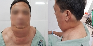 Người đàn ông ở Hà Nội thành “dị nhân” sau 40 năm uống rượu