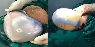 Hai em bé sinh đôi vừa sinh ra đã nằm trong bọc ối có hình trái tim