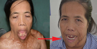 Người đàn bà có hàm răng kì dị: Mất 3 tháng để tái tạo khuôn mặt