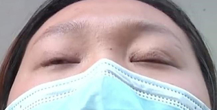 Sau khi phẫu thuật cắt mí, người phụ nữ không thể nhắm mắt khi ngủ