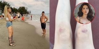 Mỹ nhân Việt mất điểm vì chân bầm tím: Ngọc Trinh "đụng độ" Ngân 98