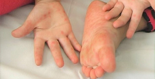 Bước vào mùa nắng, số lượng trẻ em nhập viện vì tay chân miệng tăng