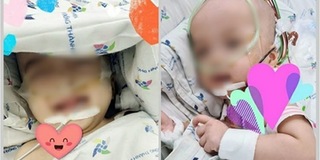 2 bé song sinh tách dính được cai máy thở, tháo bột và uống sữa ngoài