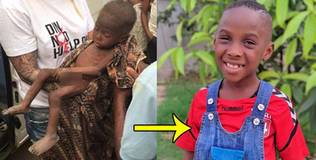 Cuộc sống hiện tại của cậu bé Nigeria tiều tụy vì suy dinh dưỡng