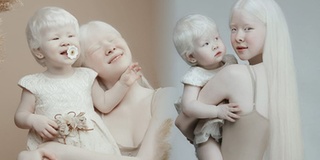 Cặp chị em bạch tạng chênh nhau 12 tuổi: Sở hữu nét đẹp tựa thiên thần