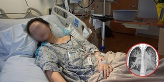 Cô gái 19 tuổi có lá phổi đục trắng vì hút thuốc lá điện tử
