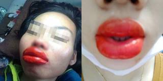 Cô gái trẻ đi xăm môi "tá hoả" vì thành quả sưng phồng như bị ong đốt