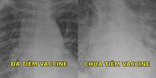 Muốn biết vaccine hiệu quả ra sao, chỉ cần nhìn phổi ca bệnh Covid-19