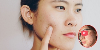 Chuyên gia lên tiếng việc peel da khiến gương mặt bị tổn thương
